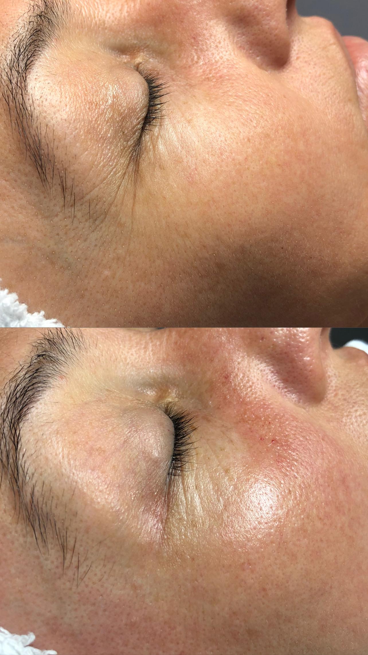 Göz çevresi bakımı